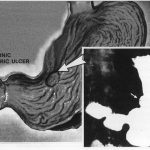 Gastritis - by Dr George - Healthy Living gastritis-1