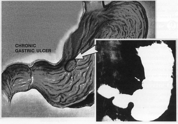 gastritis-1