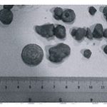 Testimony - Gallstone Flush - Lok Lei Fong testimony-human-jade-2